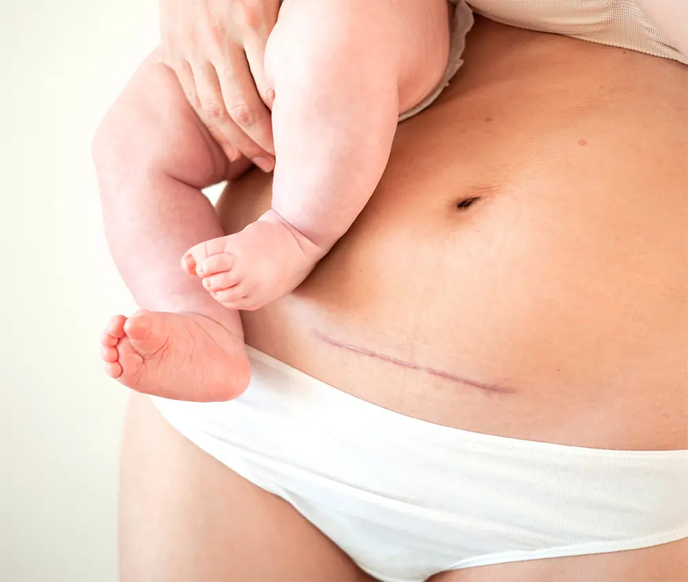 Eine Frau die ein Baby hält und einer sichtbaren Narbe eines Kaiserschnitts